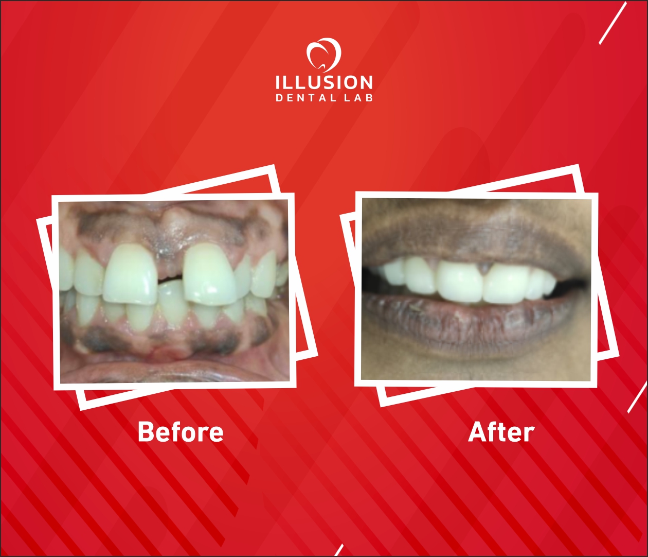 closing teeth gap treatment